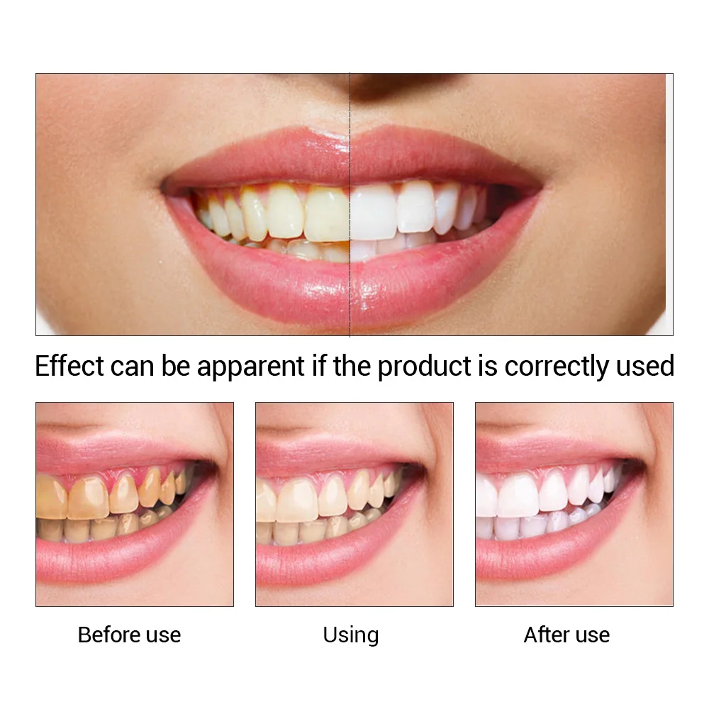 FTEENPLY Zahnaufhellung Essenz – Teeth Paint Whitening Bewertung und Preis