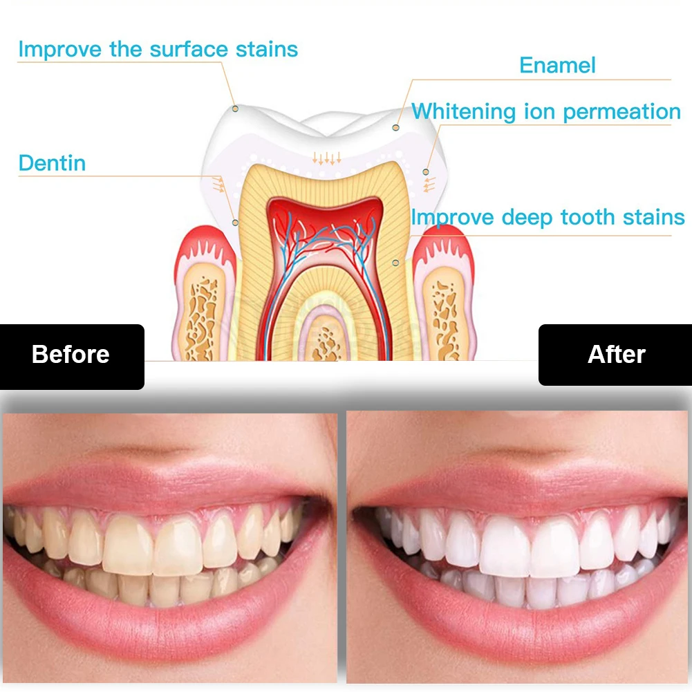 Dental Zahnaufhellung Kit Mini – Teeth Whitening With Peroxide Bewertung und Preis